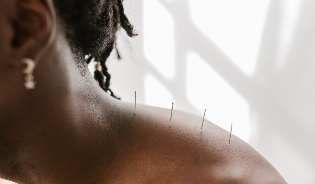 Woman with acupuncture needles in shoulder